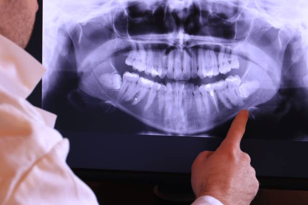 Best Emergency Root Canal Treatment in Bad Axe, MI