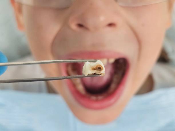 Best Urgent Care for Lost Fillings or Crowns in Bad Axe, MI